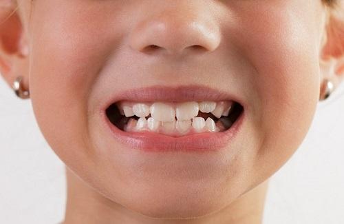 Răng mọc lệch ở trẻ em - Nguyên nhân và cách phát hiện bệnh sớm