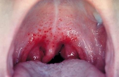 Viêm họng xung huyết là bệnh gì? Triệu chứng, nguyên nhân và điều trị bệnh