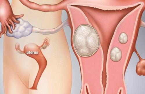 Những thông tin cần biết về bệnh lý u xơ tử cung mà chị em nên lưu ý