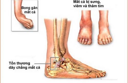 Hội chứng ống cổ chân là gì? Triệu chứng, nguyên nhân và cách điều trị