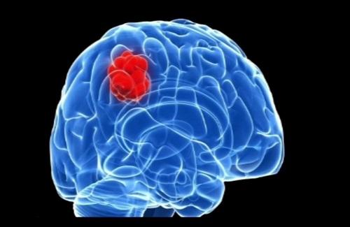 Một số nguyên nhân u não phổ biến mà có lẽ bạn chưa biết