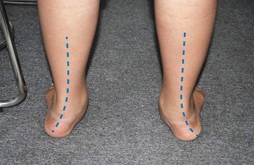 Hội chứng bàn chân bẹt và những thông tin cần thiết về hội chứng này