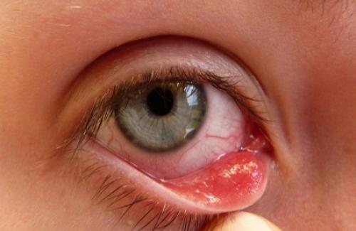 Xuất huyết mắt là bệnh gì? Triệu chứng, nguyên nhân và các điều trị bệnh