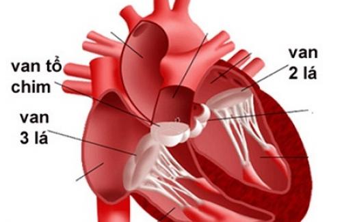 Bệnh hẹp van tim - Dấu hiệu, nguyên nhân và điều trị bệnh