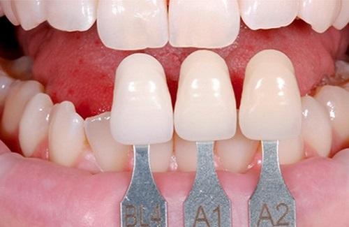 Làm răng thẩm mỹ - Một số phương pháp làm răng thẩm mỹ phổ biến hiện nay