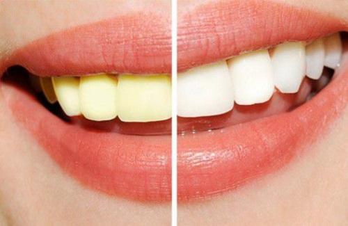 Các phương pháp tẩy trắng răng an toàn và hiệu quả hiện nay