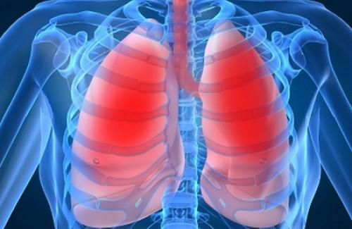 Nhồi máu phổi là bệnh gì? Triệu chứng, nguyên nhân và điều trị bệnh
