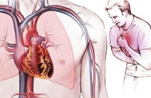 Bệnh xơ vữa động mạch - Triệu chứng, nguyên nhân và điều trị bệnh