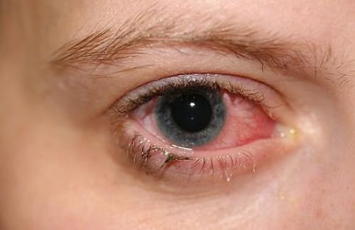 Bệnh đau mắt đỏ (viêm kết mạc) - Triệu chứng, nguyên nhân và điều trị bệnh