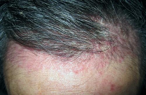 Vảy nến da đầu và những thông tin cần thiết về căn bệnh này