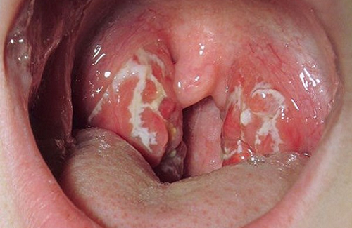 Bệnh lậu ở miệng - Một trường hợp của bệnh lậu không thể xem thường