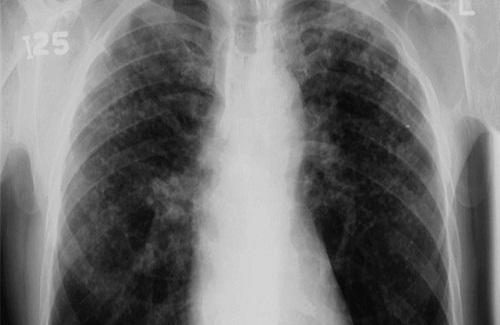 Bệnh bụi phổi silic và những nguyên nhân bệnh bụi phổi silic