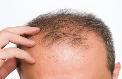 Nguyên nhân rụng tóc ở nam giới thường gặp mà có lẽ bạn chưa biết
