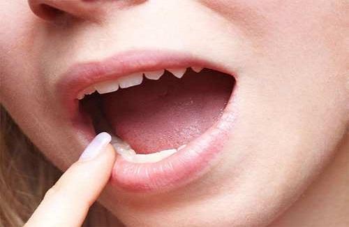 Sùi mào gà ở lưỡi - Biểu hiện, tác hại và cách điều trị hiệu quả cho bạn