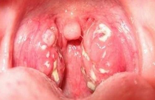 Bệnh sùi mào gà ở vòm họng - Một thể bệnh sùi mào gà bạn nên lưu ý