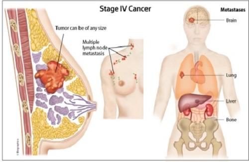 Ung thư vú giai đoạn cuối - Các dấu hiệu ung thư vú giai đoạn cuối bạn nên lưu ý