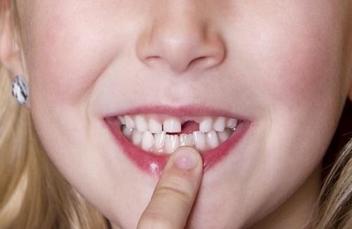 Chảy máu chân răng ở trẻ em và một số lưu ý cho các bậc cha mẹ
