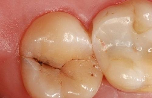 Sâu răng hàm ở trẻ em - Nguyên nhân và tác hại sâu răng hàm ở trẻ
