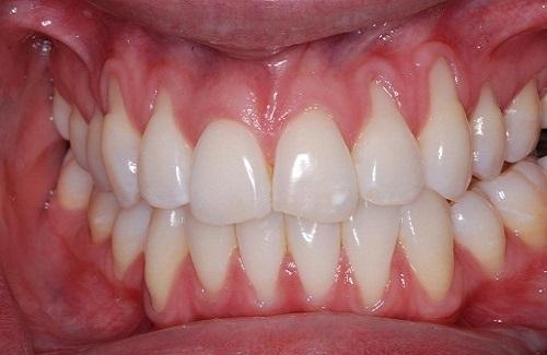 Chữa viêm chân răng tại nhà hiệu quả với các cách dưới đây