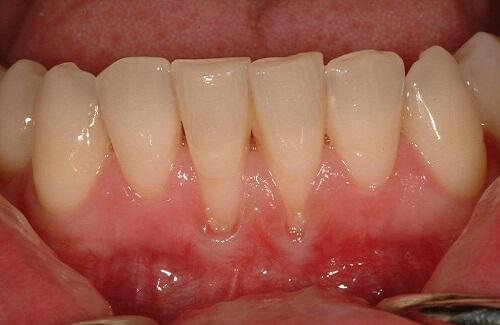 Viêm chân răng - Nguyên nhân và triệu chứng viêm chân răng