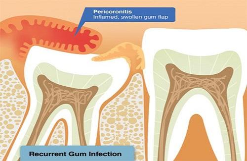 Viêm lợi trùm răng khôn - Cách giảm đau và phương pháp điều trị hiệu quả