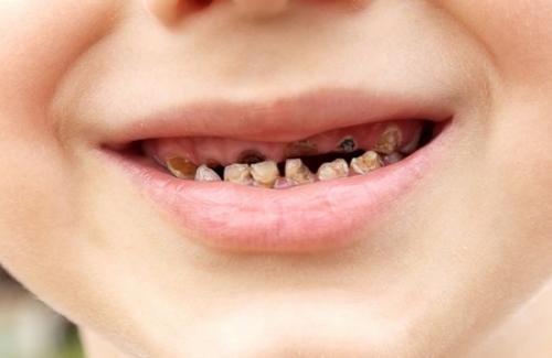 Sâu răng là gì? Triệu chứng, nguyên nhân và điều trị sâu răng
