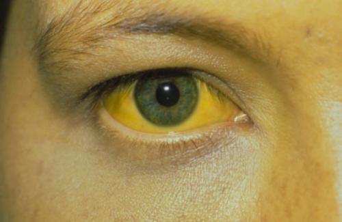 Vàng mắt là bệnh gì? Vàng mắt ở người mắc bệnh gan