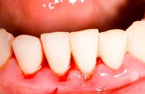 Những lý do không thể xem thường khi bị chảy máu chân răng