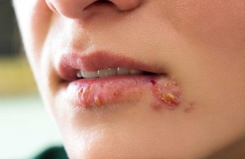 Bệnh herpes là gì? Triệu chứng, nguyên nhân và cách phòng tránh bệnh
