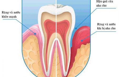 Viêm quanh răng là gì? Triệu chứng, nguyên nhân và cách phòng ngừa