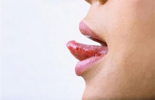 Bệnh nấm miệng là gì? Triệu chứng, nguyên nhân và điều trị bệnh