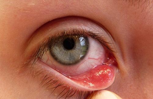Triệu chứng đau mắt hột thường gặp mà có thể bạn chưa biết