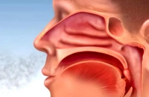Bệnh polyp mũi là gì? Triệu chứng, nguyên nhân và điều trị bệnh