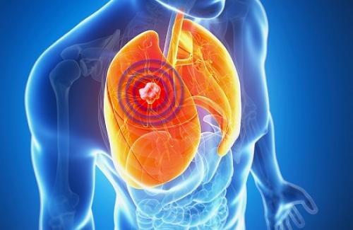 Viêm phổi kẽ - Triệu chứng, nguyên nhân và điều trị viêm phổi kẽ