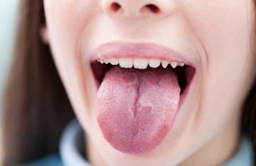 Bệnh bạch sản miệng là gì? Triệu chứng, cách phòng và điều trị bệnh