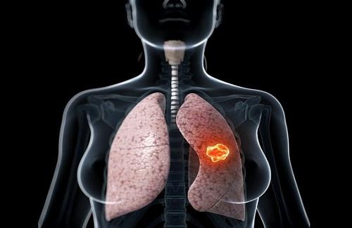 Bệnh Ung thư phổi - Những dấu hiệu cơ bản thường gặp