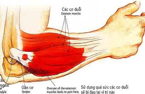 Chữa đau khớp khuỷu tay - Cách chữa đơn giản từ Đông y