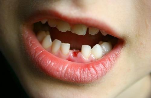 Chấn thương răng trẻ em và một số biện pháp khắc phục tình trạng này