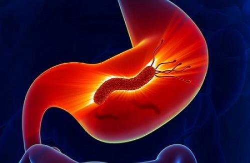 Bệnh viêm hang vị dạ dày là gì? Triệu chứng, nguyên nhân và điều trị bệnh