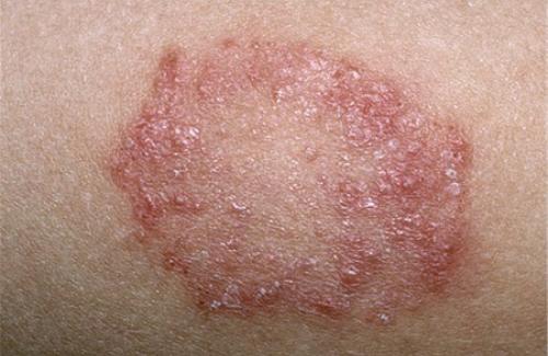 Lao da là bệnh gì? Nguyên nhân và phương pháp điều trị lao da