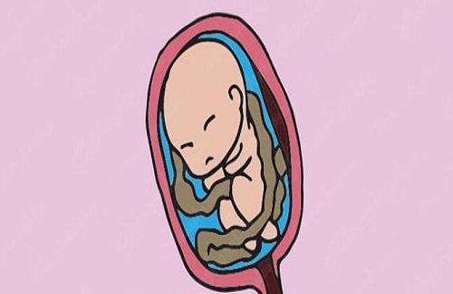 Thiếu nước ối khi mang thai và những điều bạn nên biết