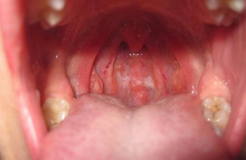 Ung thư vòm họng là bệnh gì? Triệu chứng, nguyên nhân và điều trị bệnh
