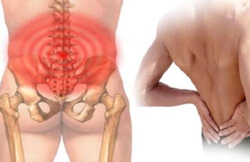 Đau vùng thắt lưng - Biểu hiện của căn bệnh nhuyễn xương