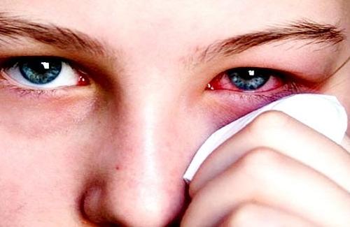 Trị bệnh đau mắt đỏ với bài thuốc từ dân gian hiệu quả