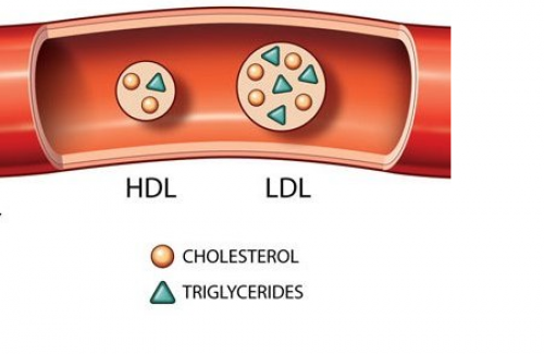 LDL cholesterol là gì? Triệu chứng, nguyên nhân và cách điều trị