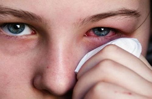 Bệnh đau mắt đỏ - Nguyên nhân và cách phòng tránh