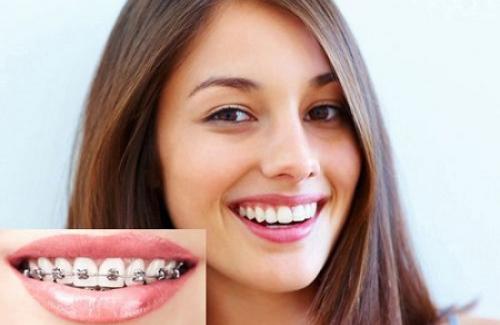 Răng khấp khểnh là gì? Triệu chứng, nguyên nhân và điều trị răng khấp khển