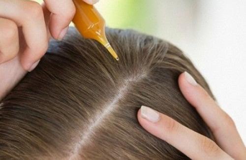 Bệnh vảy nến da đầu là gì? Triệu chứng, nguyên nhân và điều trị bệnh