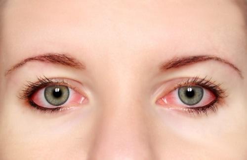 Bật mí cách phòng bệnh đau mắt đỏ đúng cách để đạt hiệu quả tốt nhất