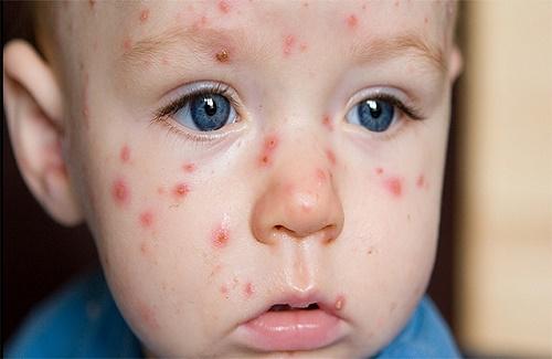 Sáu bệnh ngoài da ở trẻ thường hay gặp vào mùa nắng nóng